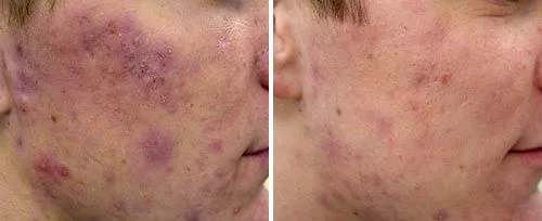 active_acne3_sult_rn